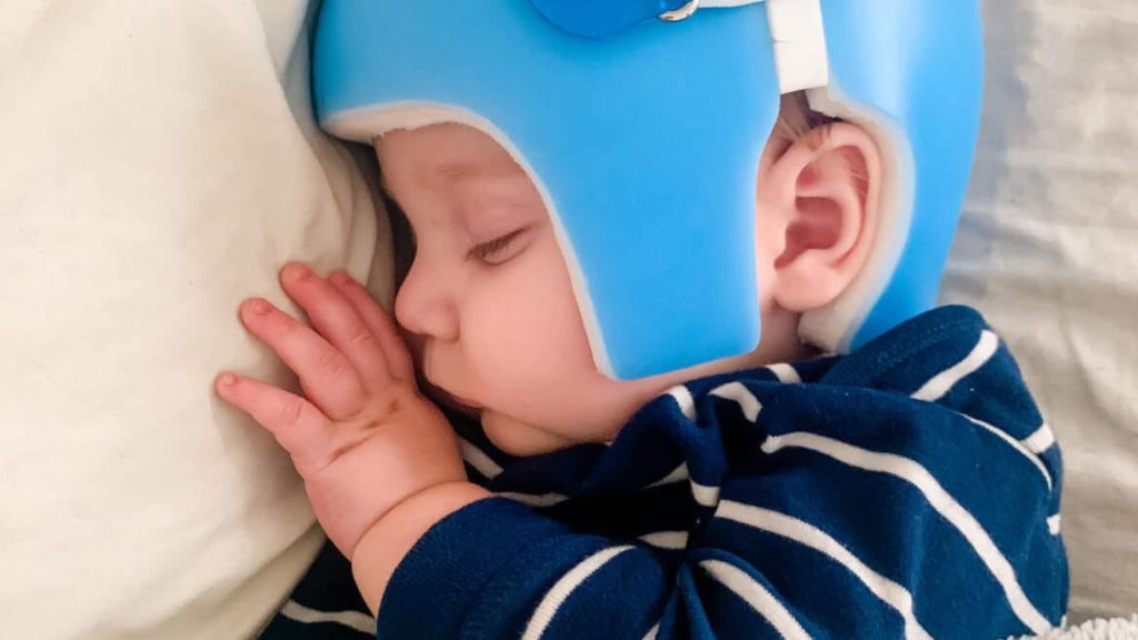baby sleeping with head shaping helmet