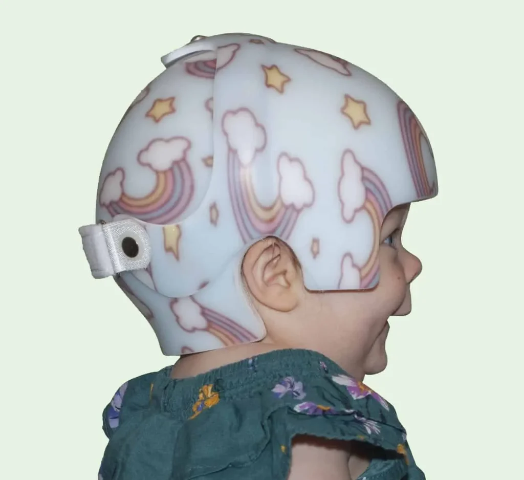 baby head shape correction Starband Bi valve helmet therapy