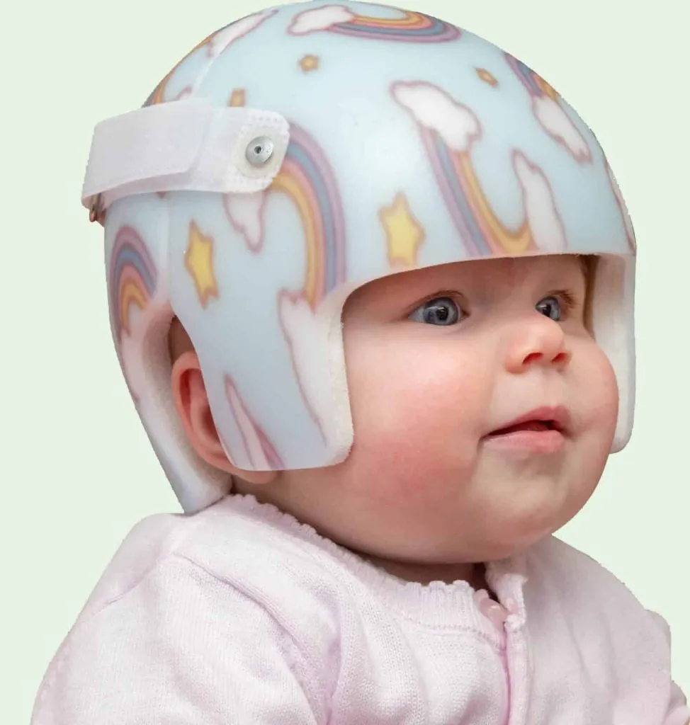 infant with starband plus cranial remolding helmet