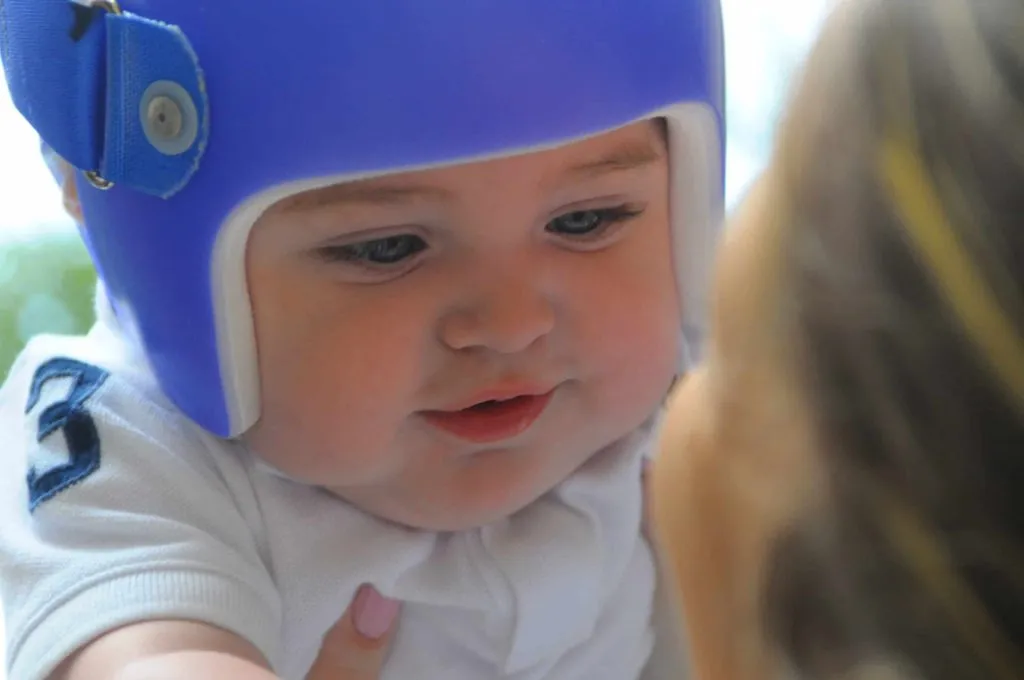 an infant with a head shaping helmet therapy