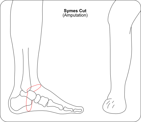 Syme amputation showing heel pad preservation at ankle joint
