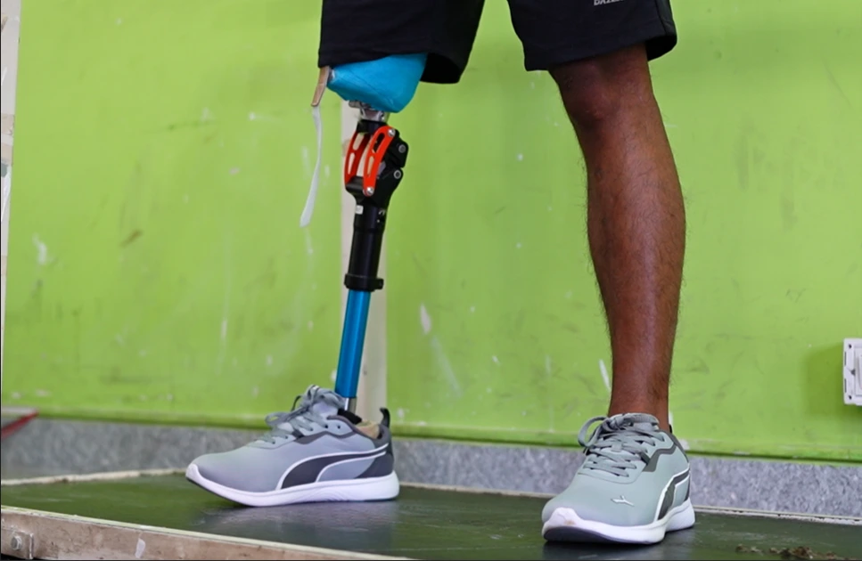 Above knee amputation showing surgical site and recovery stage