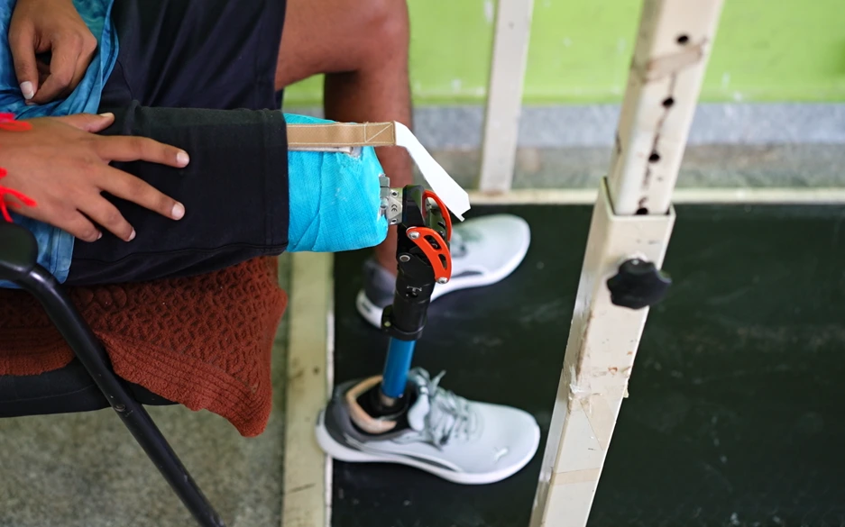 Modern above knee prosthesis for enhanced mobility and support