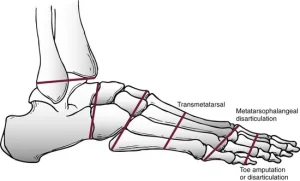 Different types of foot amputation including transmetatarsal, Lisfranc, Chopart, and Syme’s levels