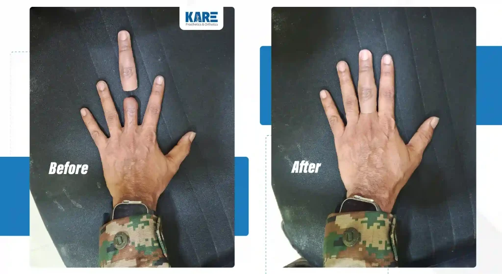 Before and after results of artificial finger prosthesis showing natural look and restored hand appearance