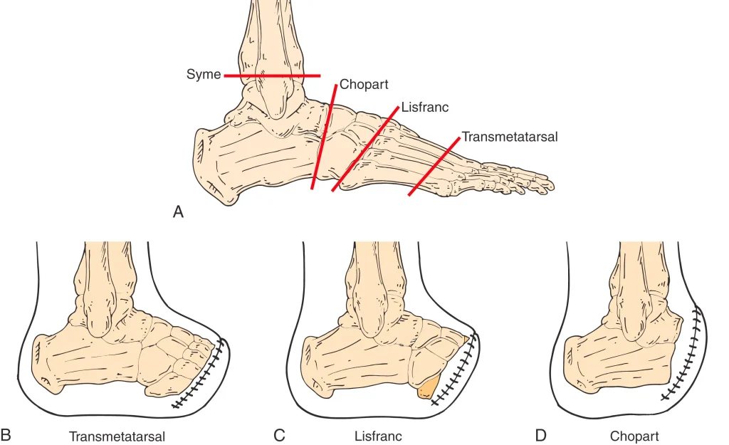 Illustration showing Chopart amputation at the midfoot, preserving the talus and calcaneus bones