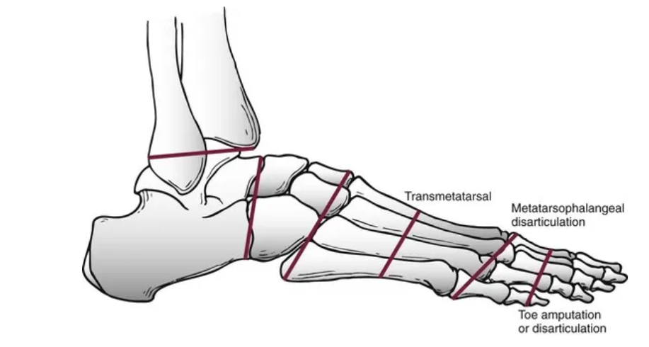 Medical illustration of Lisfranc amputation, where the forefoot is surgically removed at the tarsometatarsal joint while preserving the hindfoot and ankle