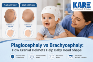 A baby wearing a cranial helmet beside a plagiocephaly and brachycephaly head-shape comparison.